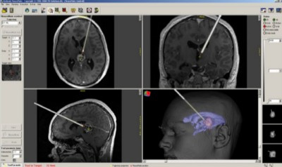 Zpětná vazba k poloze hrotu sondy v reálném čase na navigační stanici neuromate. Tumor v oblasti corpus pineale je znázorněn fialově. Zpětná vazba k poloze hrotu sondy v reálném čase na navigační stanici neuromate. Tumor v oblasti corpus pineale je znázorněn fialově.